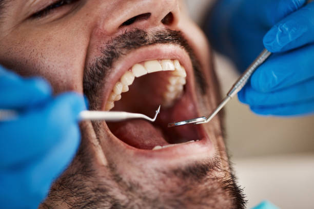 Best Emergency Care for Gum Disease in Cade, LA