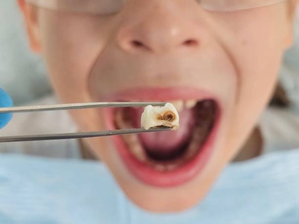 Best Emergency Treatment for Oral Infections in Cade, LA